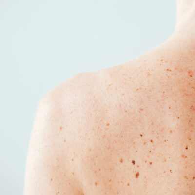 Major Complications Caused by Melanoma