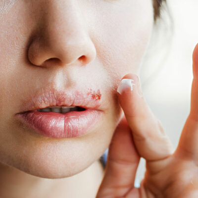 Effective Cold Sore Treatment Options