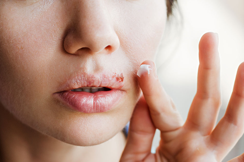 Effective Cold Sore Treatment Options