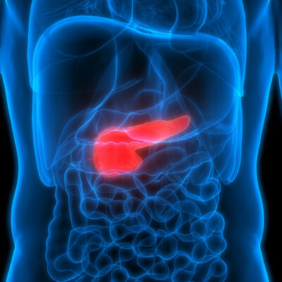 Genetic and Hereditary Risk Factors for Pancreatic Cancer