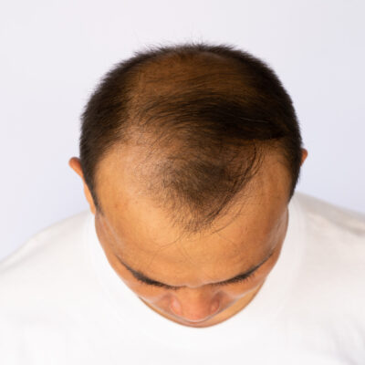 Top Treatment Options for Male Pattern Baldness