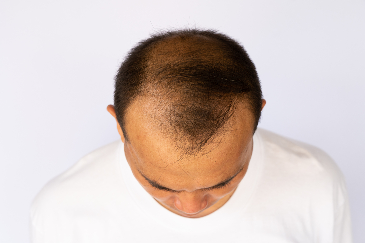 Top Treatment Options for Male Pattern Baldness