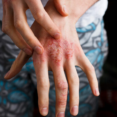 Triggers That Worsen Atopic Dermatitis