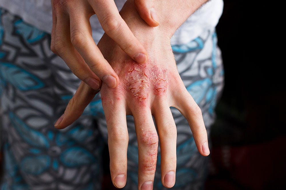 Triggers That Worsen Atopic Dermatitis