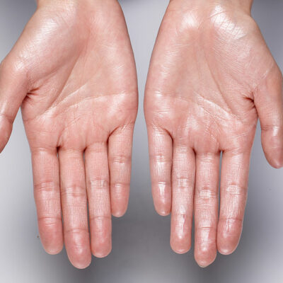 5 Medical Causes and Symptoms for Heavy Sweating